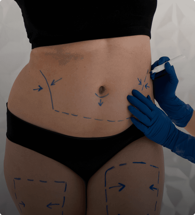 Liposuction