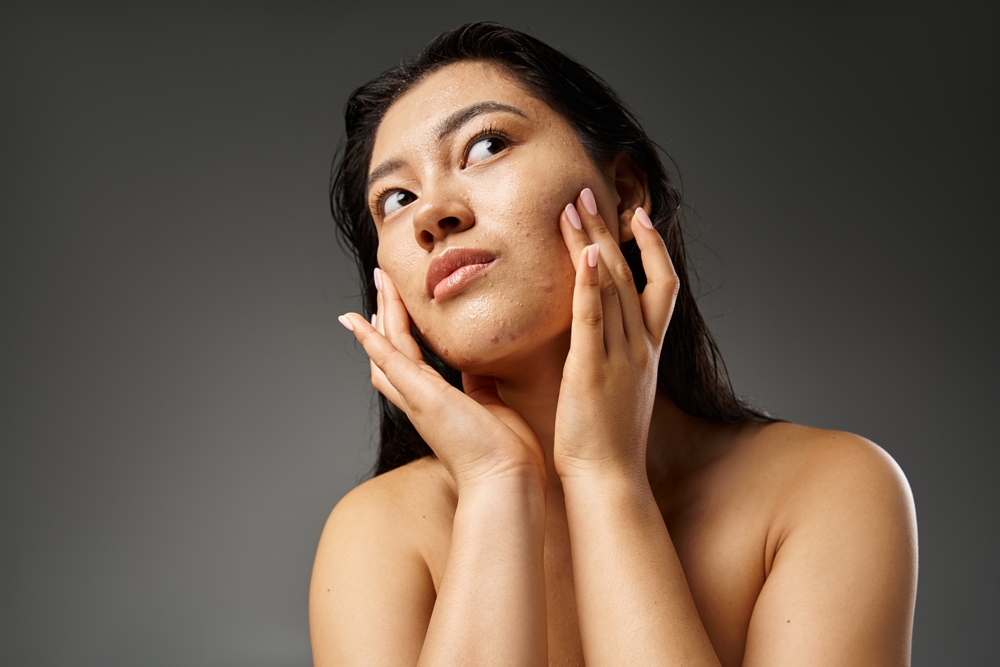 Acne Treatment