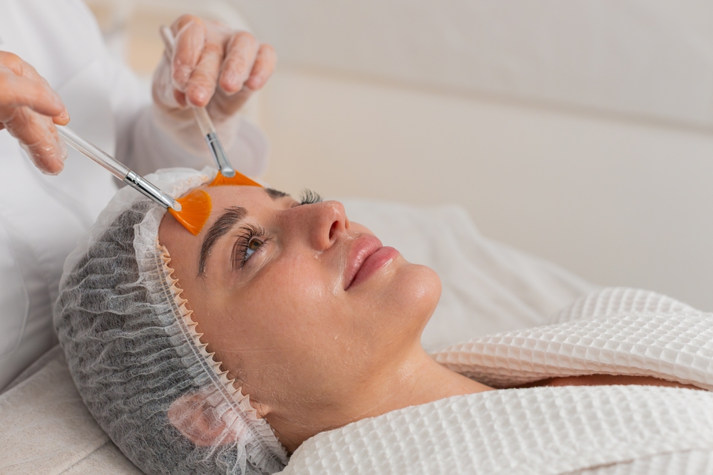 Chemical Peel