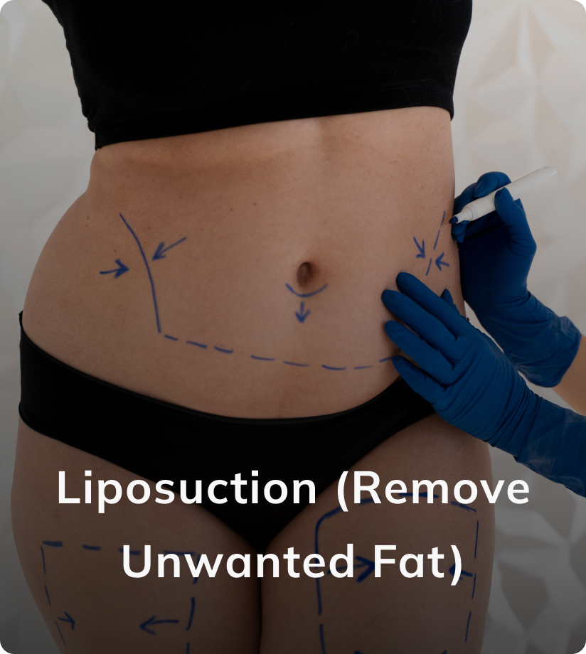 Liposuction