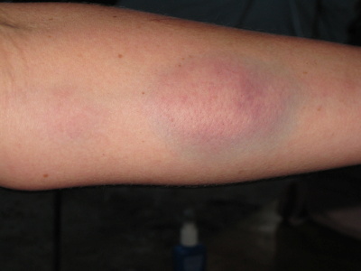 Bruising after arm liposuction procedure