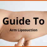 guide to arm liposuction in malaysia