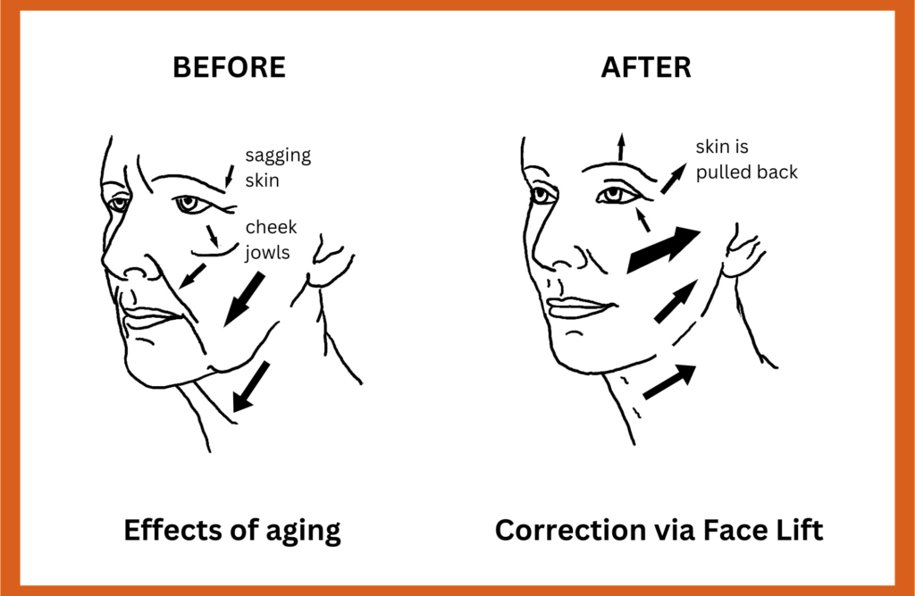 diagram showing before and after facelift on cheeks neck and forehead with tighter skin