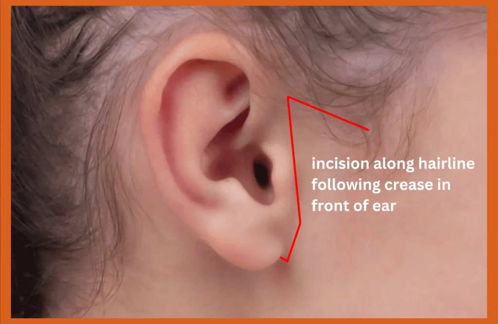 human ear with incision line sketch to show how facelift procedure is done