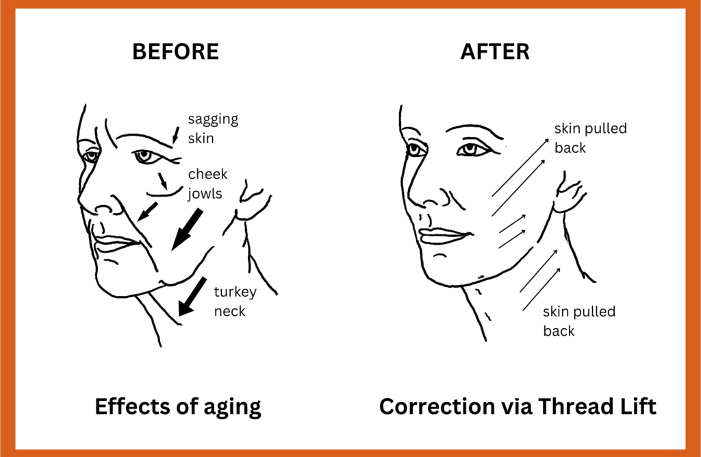 diagram showing before and after a thread lift procedure with the patient having firm and non-sagging skin