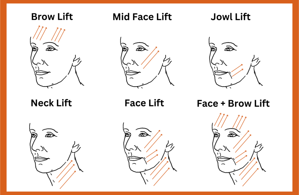 diagram showing different types of thread lifts applied to different parts of the face including neck, jowls, and brows